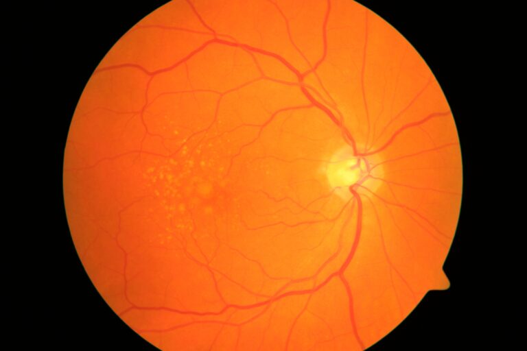 Macular Degeneration – Sunshine Eye Clinic